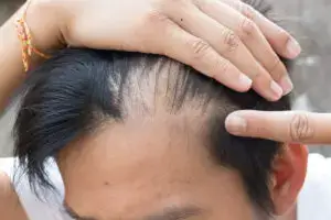 कीटो डाइट से बाल गिरने की समस्या और उससे कैसे बचें Keto diet hair fall  problem – Net In 